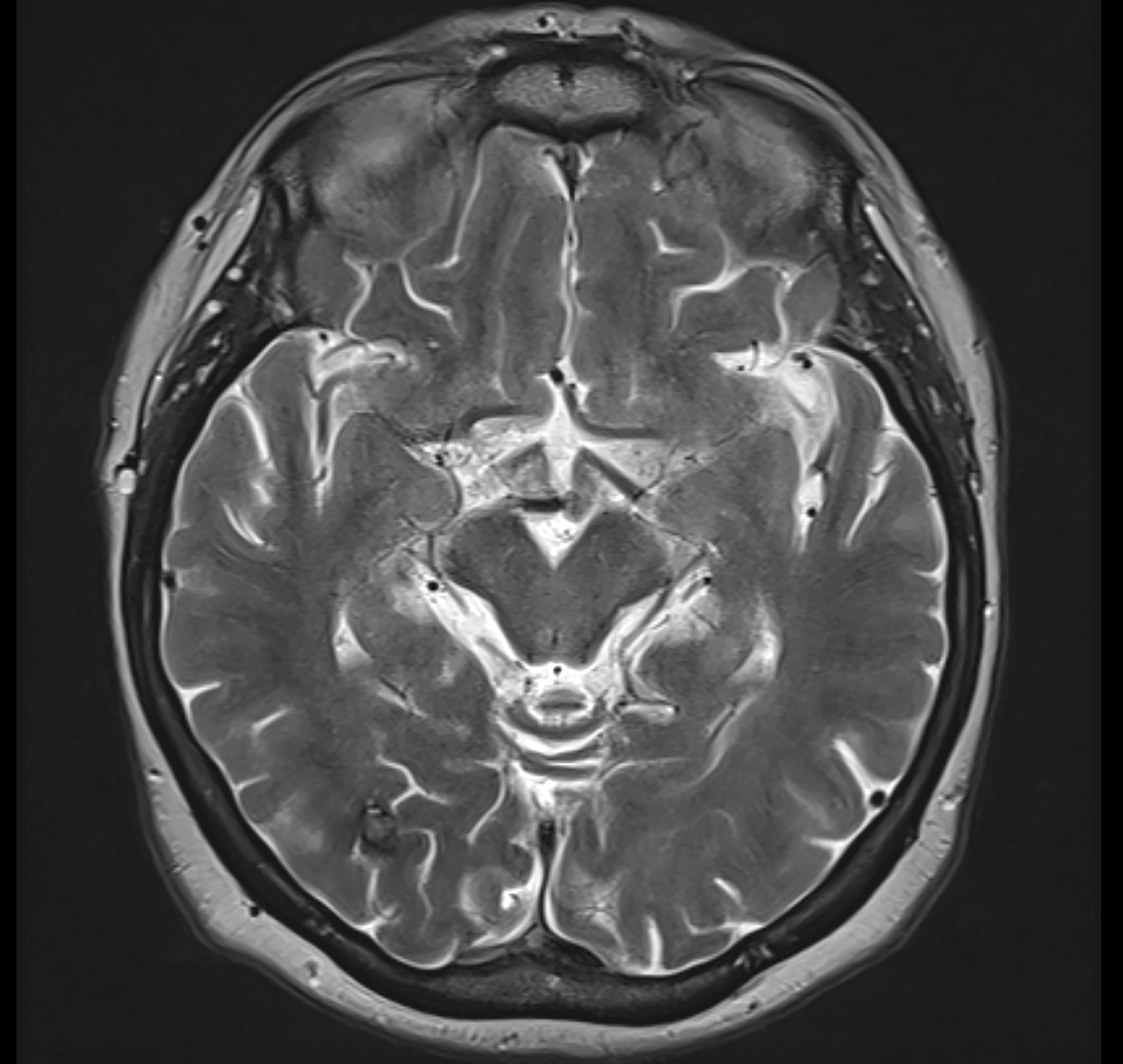 MRI scan of a human brain, showing detailed structures, used for medical analysis or study