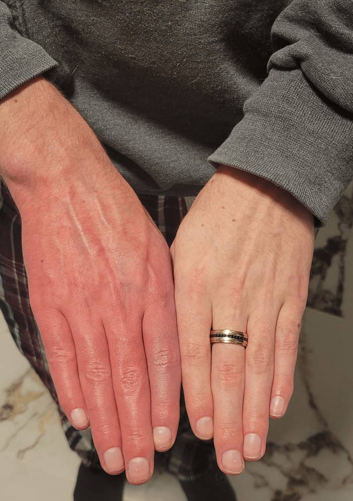 Two hands side by side, one slightly redder than the other, both wearing a ring on the ring finger