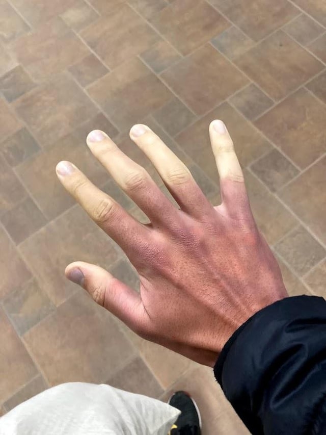 Hand with uneven skin tone, possibly due to temperature change, showing a stark contrast between paler and darker sections