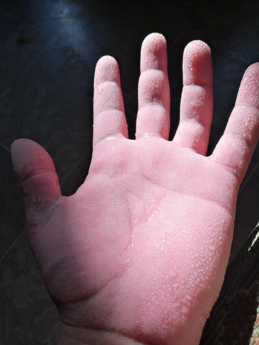 A close-up of a hand covered with tiny ice crystals, giving the appearance of frost or cold exposure