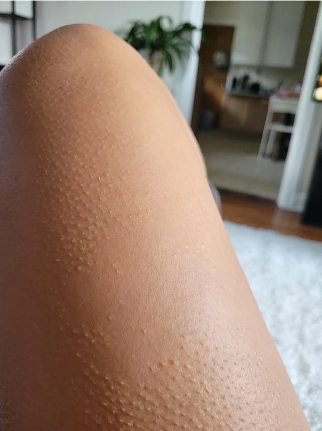 Close-up of a person's leg with visible goosebumps, indoors with blurred background