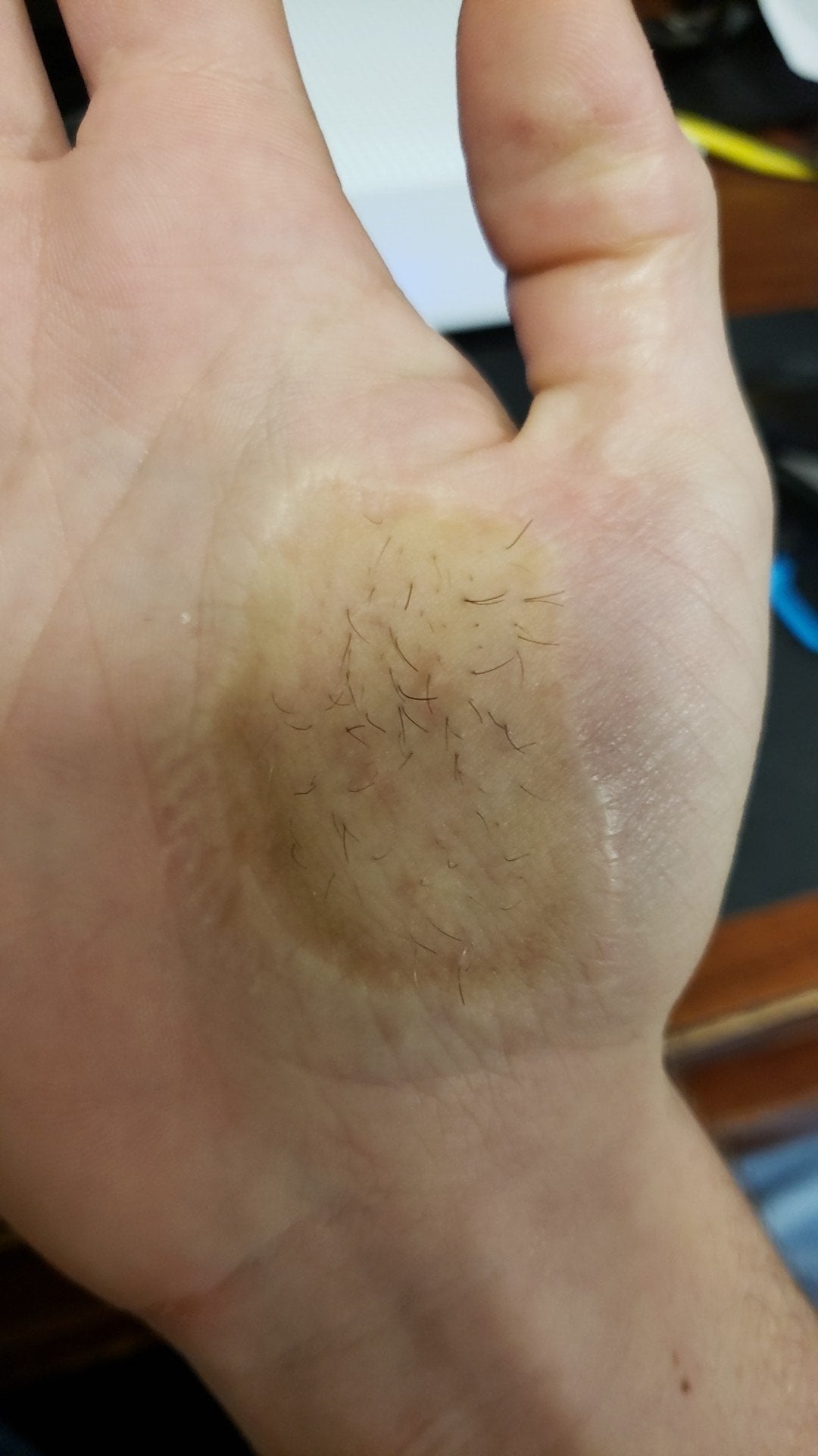 Close-up of a person's palm with an unusual amount of hair growing in the center area