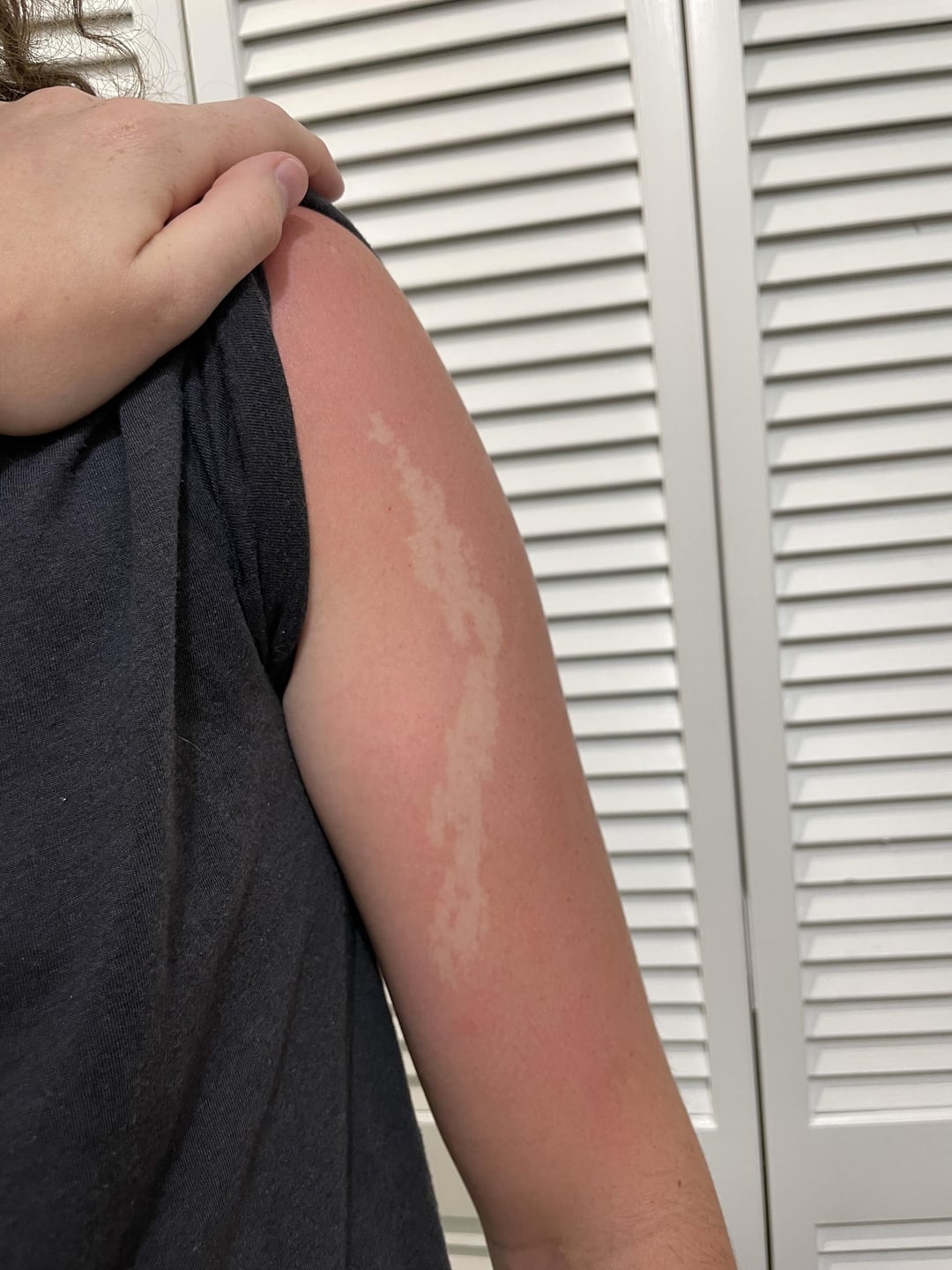 A person with a vitiligo patch on their upper arm, wearing a sleeveless top, stands in front of white louvered doors