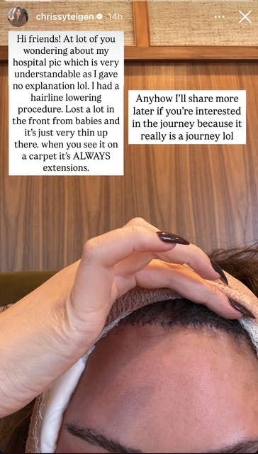 Chrissy Teigen's forehead after undergoing hairline lowering surgery