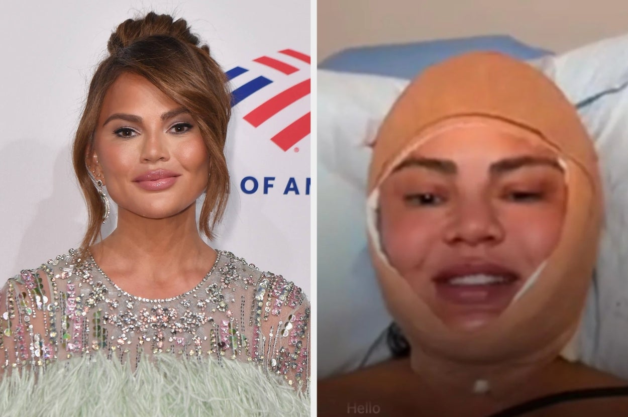 Chrissy Teigen Broke Her Silence After A Photo Of Her Bandaged Face Sparked Concern