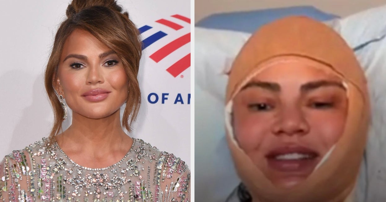 Chrissy Teigen Broke Her Silence After A Photo Of Her Bandaged Face Sparked Concern BuzzFeed Chrissy Teigen Broke Her Silence After A Photo Of Her Bandaged Face Sparked Concern BuzzFeed
