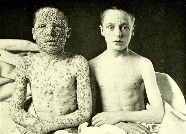 One boy with smallpox sores sits next to another boy without sores. Both are shirtless and looking at the camera