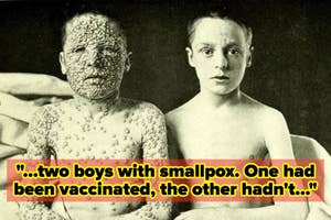 Two boys, one with smallpox lesions (unvaccinated) and the other without (vaccinated), highlight the impact of vaccination
