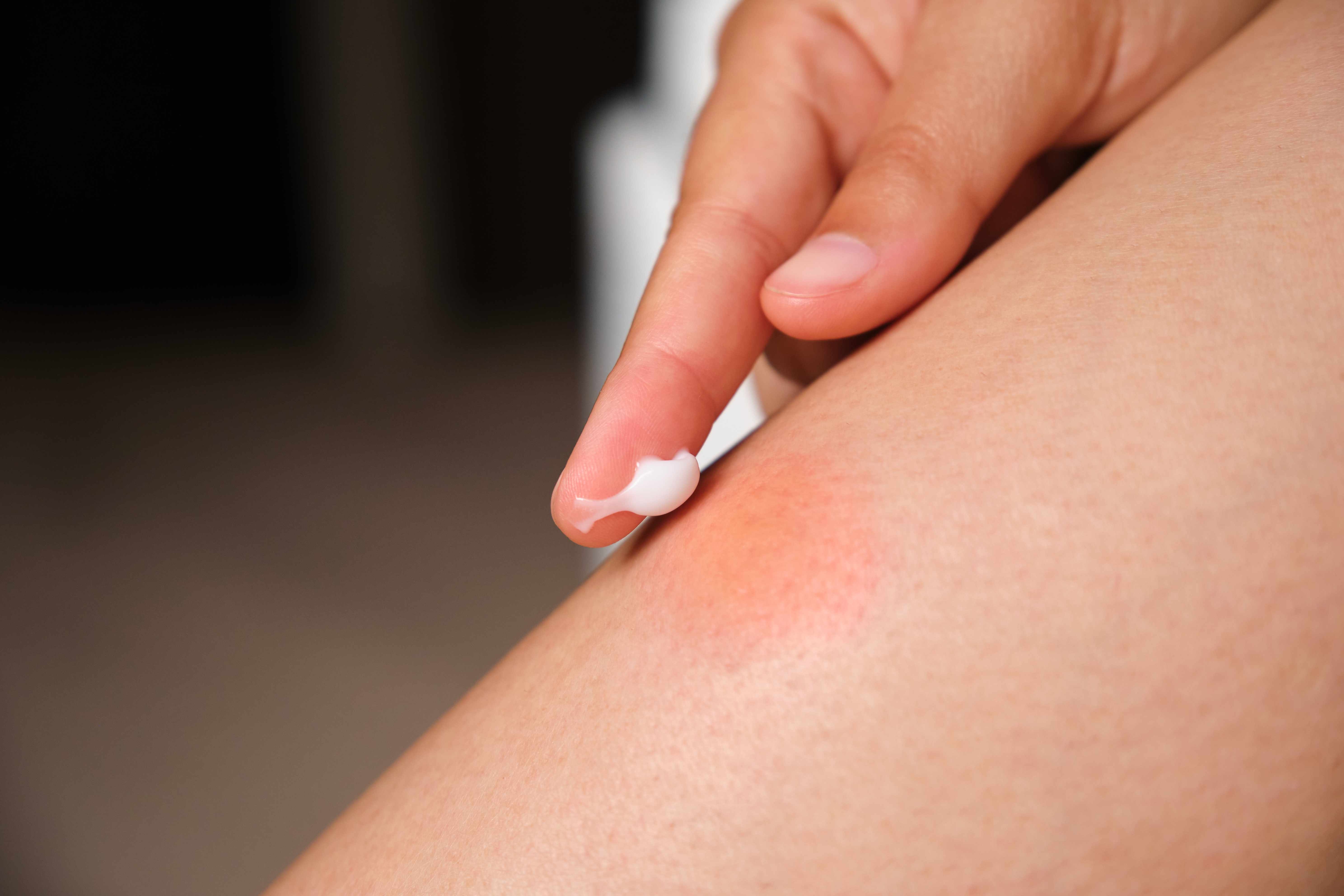 Applying a small amount of lotion to soothe skin irritation on a person&#x27;s leg