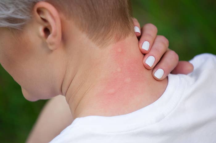 Person with short hair touching neck showing red, irritated skin with small bumps