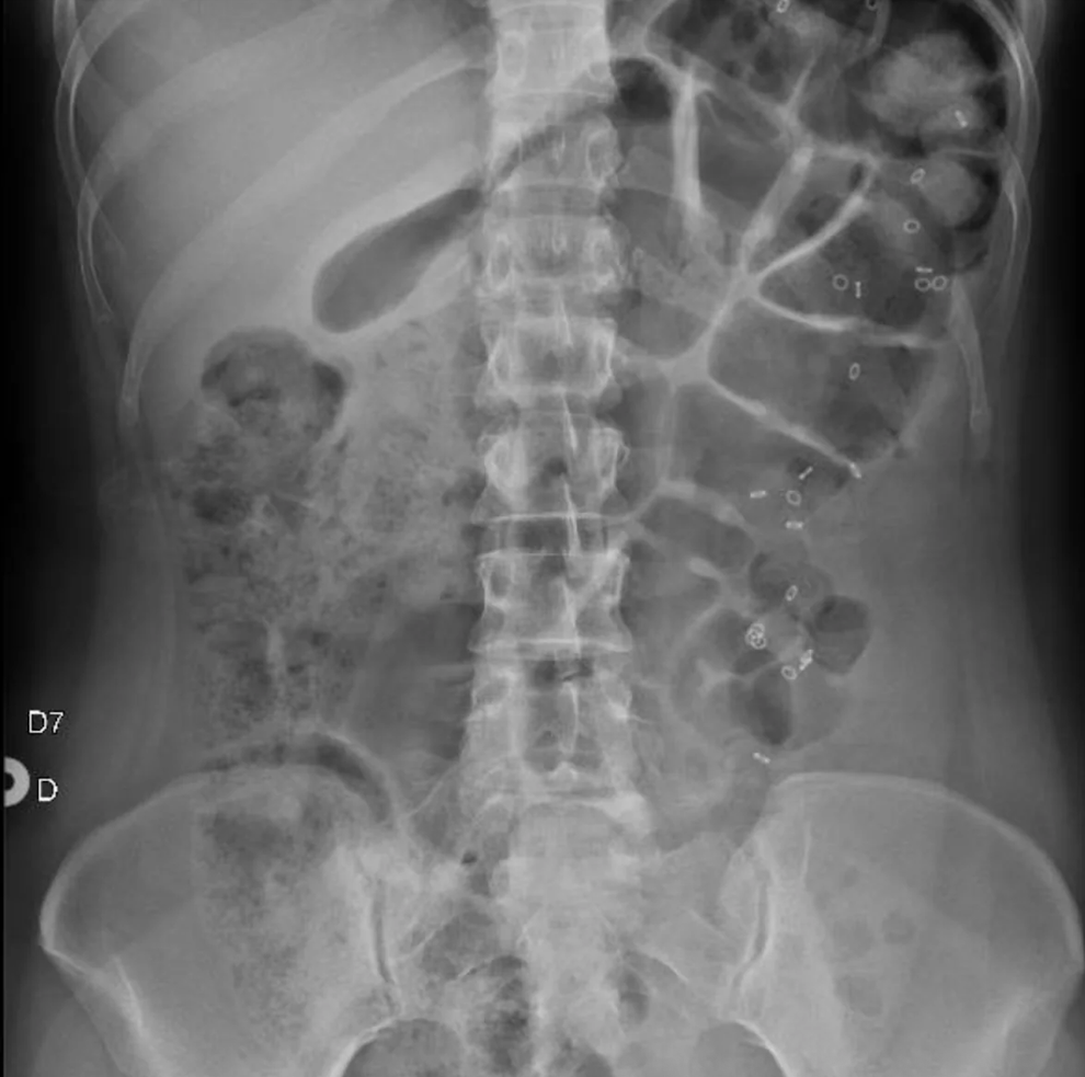 X-ray of an abdomen showing spine alignment and internal organs, with prominent vertebrae and intestinal loops visible