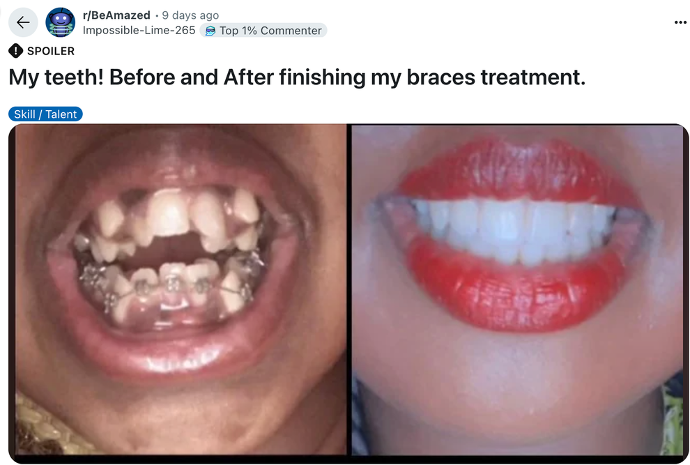 Side-by-side comparison of teeth before and after braces; before shows braces, after shows straightened teeth and visible red lipstick