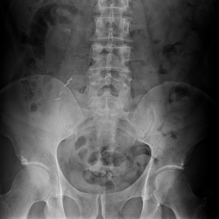 X-ray image showing the lower spine and pelvic region, highlighting bone structures and alignment