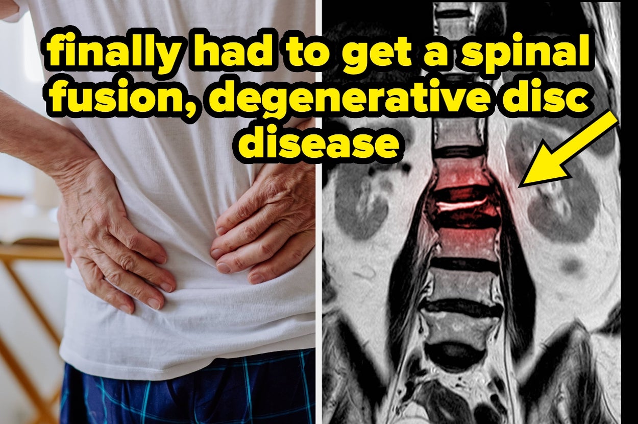 Person holding lower back in pain; MRI scan shows spinal issue. Text discusses spinal fusion for degenerative disc disease
