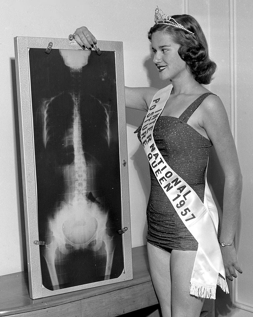 Woman in swimsuit and tiara with "Posture National Queen 1957" sash stands next to an X-ray display