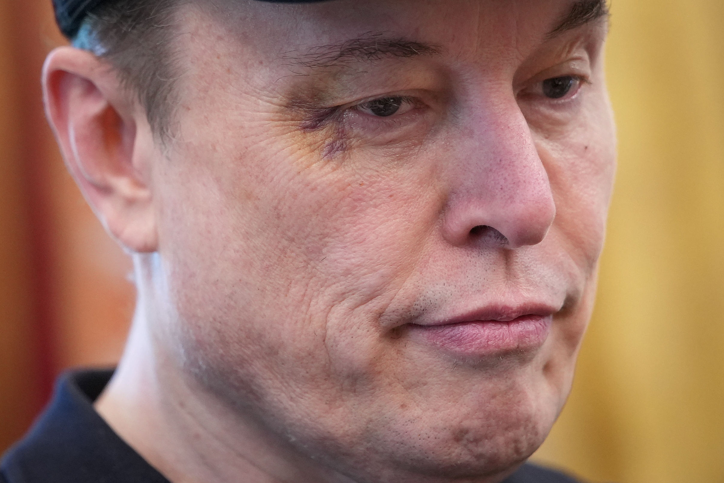 Elon Musk with a noticeable bruise under their eye looks down pensively, wearing a casual hat and shirt