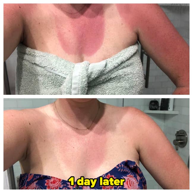 Two images amusement a idiosyncratic with sunburned tegument earlier and aft treatment, wearing a towel and patterned top
