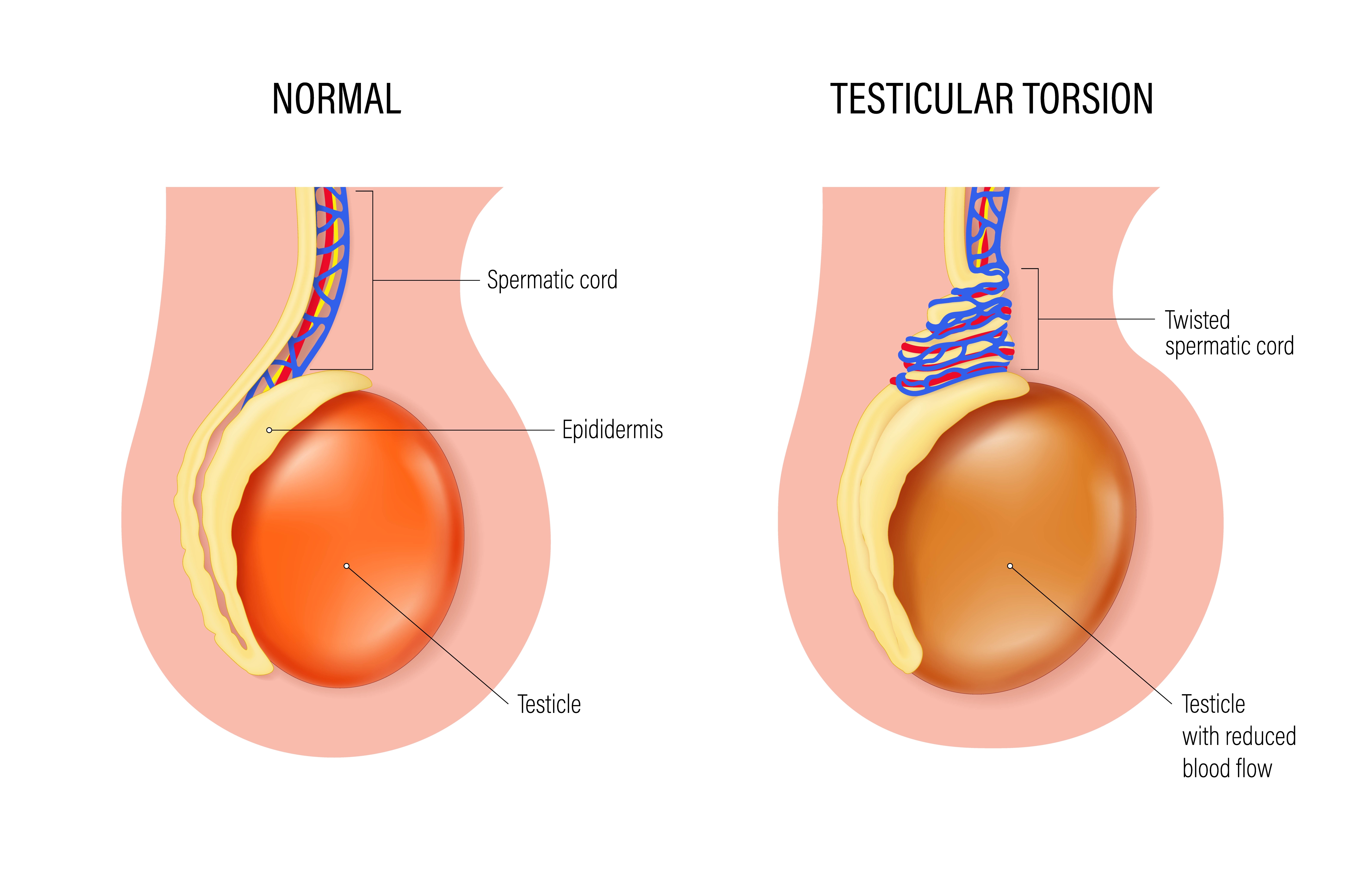 Diagram showing a normal testicle on the left and testicular torsion on the right, with labeled parts: spermatic cord, epidermis, and blood flow details