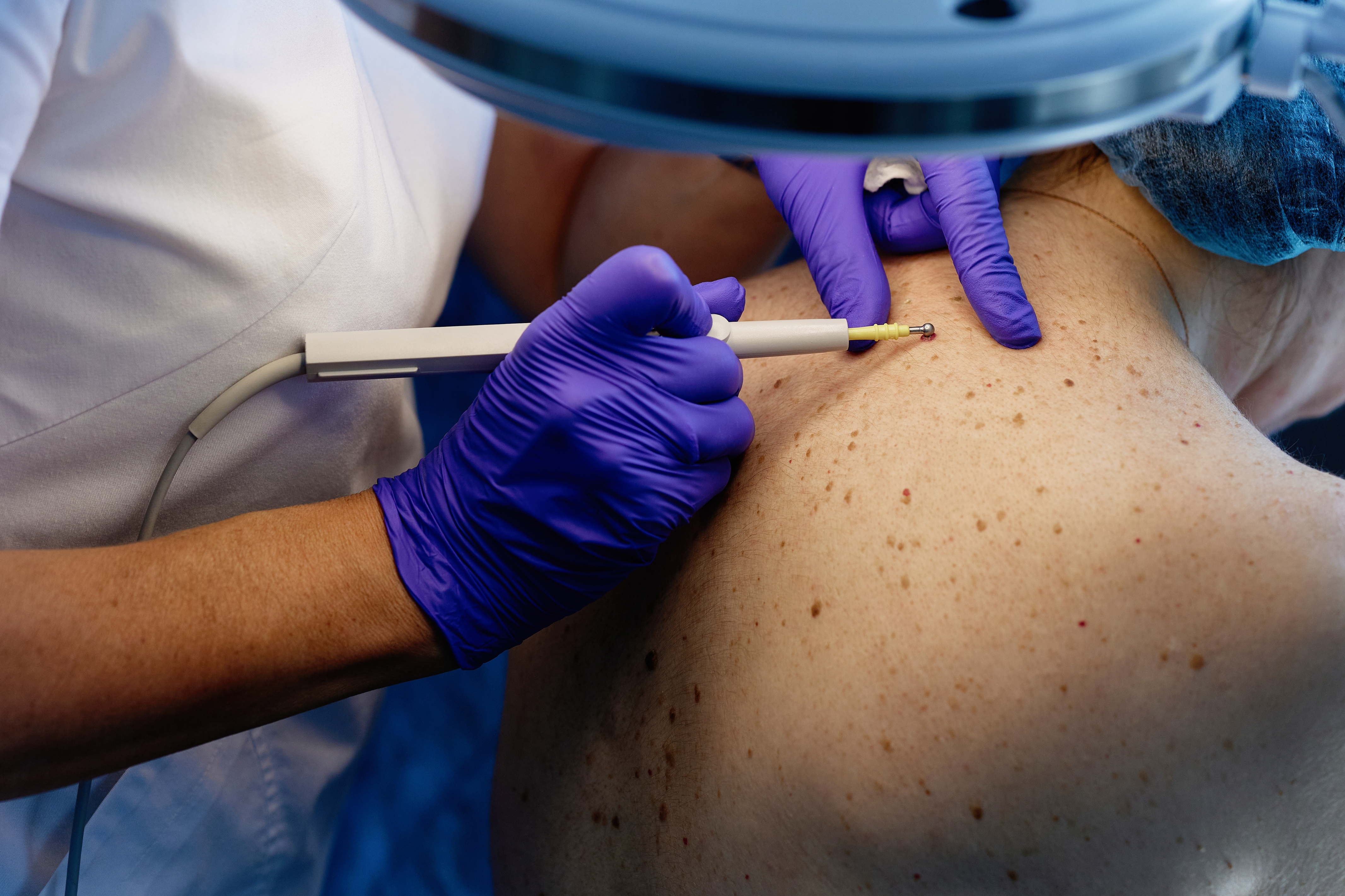 Profesjonell helsepersonell som bruker hansker undersøker og behandler føflekker på en pasients rygg med medisinsk utstyr med medisinsk utstyr