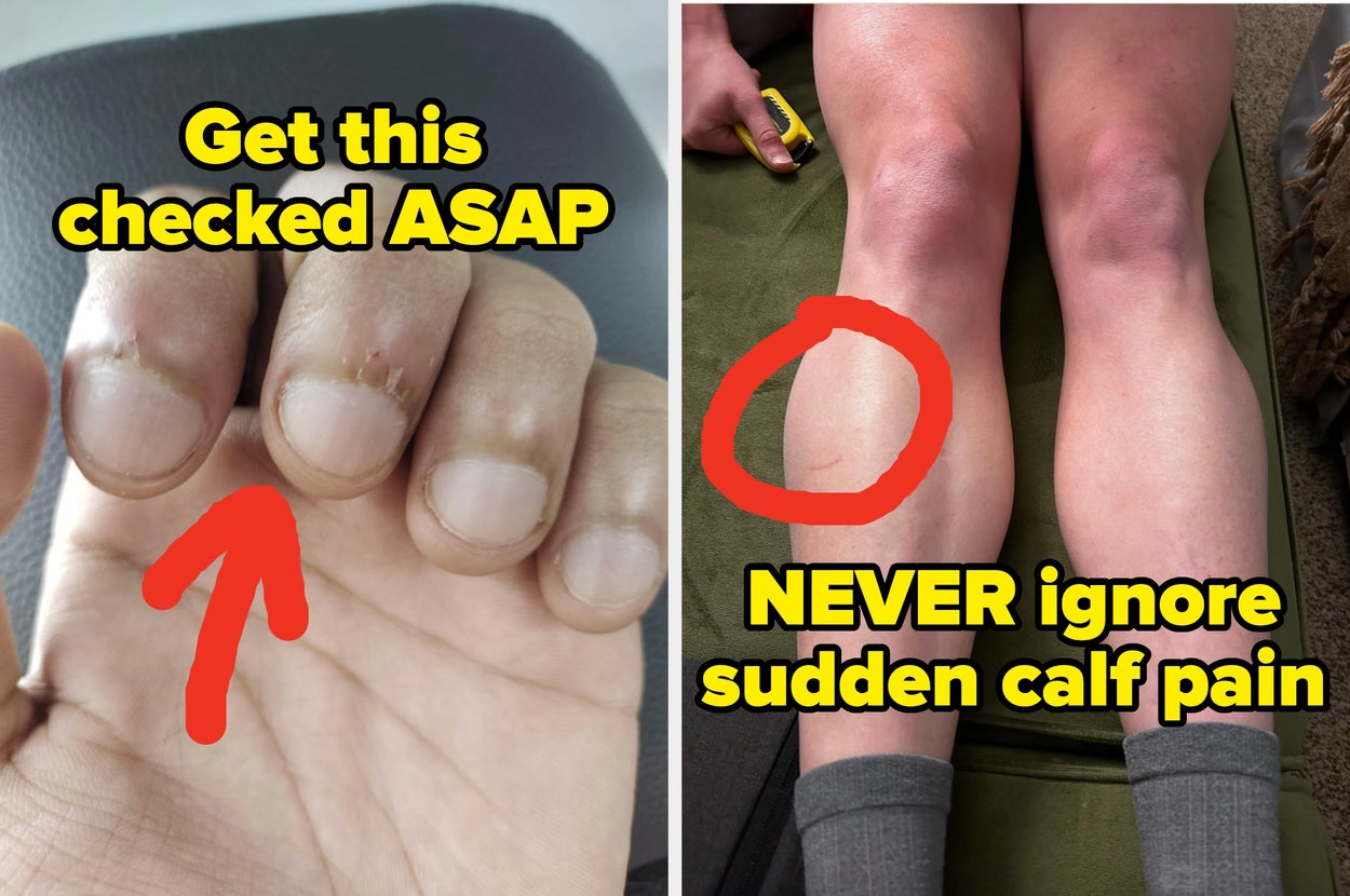 Two images: Left shows a hand with clubbed nails, text warns "Get this checked ASAP;" Right shows legs with calf emphasized, text says: "NEVER ignore sudden calf pain"