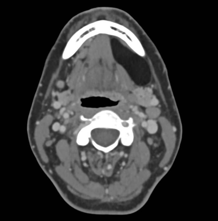 A CT scan of a quality head, viewed from the top, showing anatomical structures and tissues successful cross-section