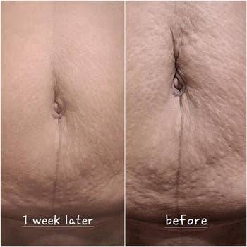 Reviewer's tegument earlier and aft utilizing bum bum cream