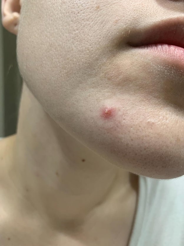 Close-up of a person's chin showing a azygous  pimple
