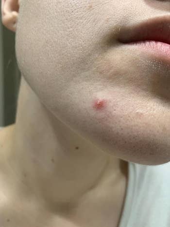 Close-up of a person's chin showing a azygous pimple