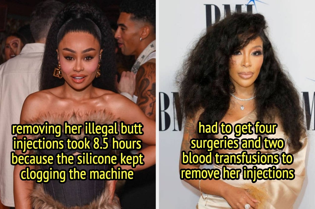 13 Celebrities Who Revealed The Shocking Consequences Of Illegal Cosmetic Procedures