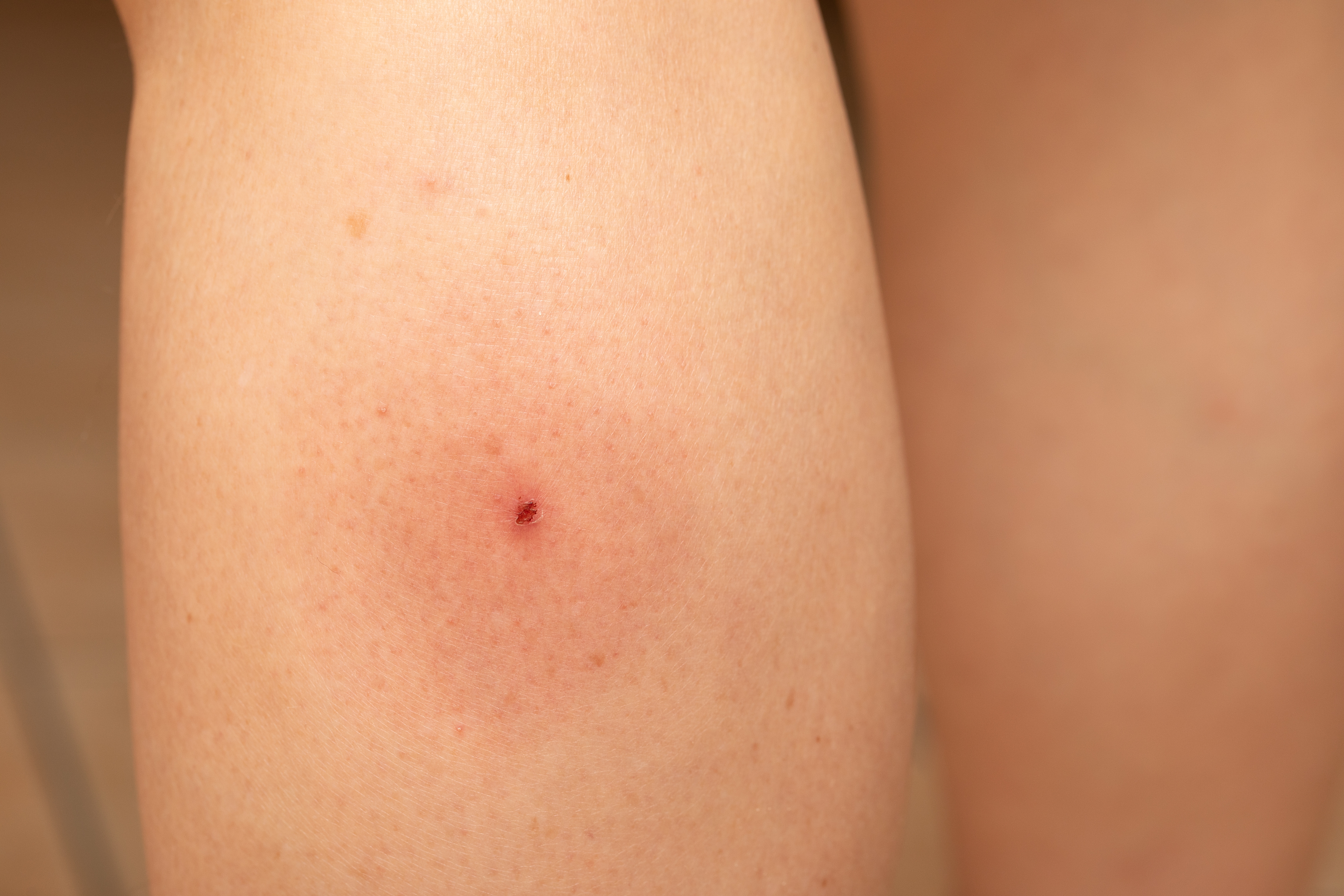 Nærbilde av en persons ben med et lite, helbredende sår, omgitt av litt betent hud