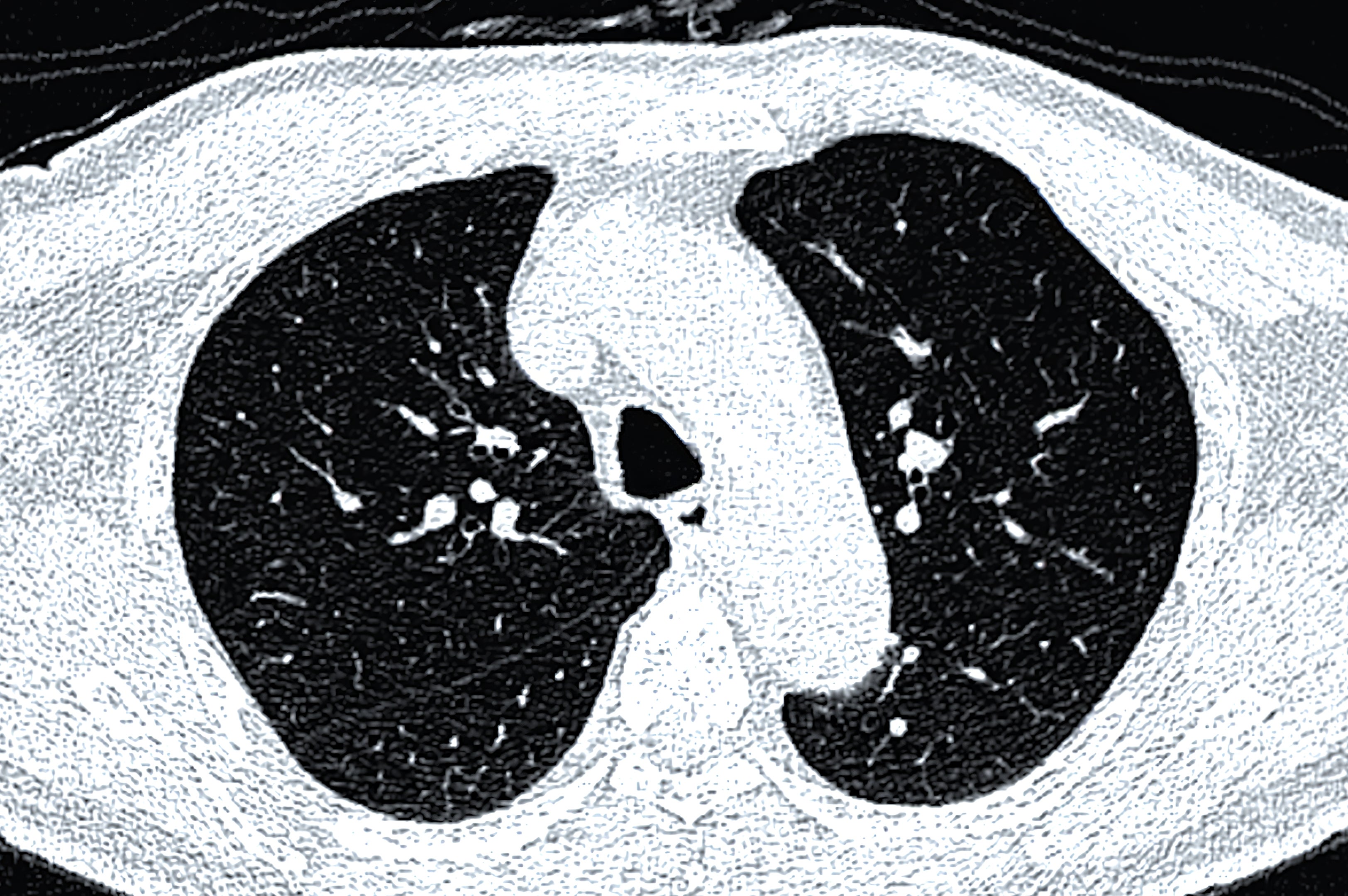 CT-skanningsbilde som viser et tverrsnitt av brystområdet, og fremhever lungestrukturer og luftveier