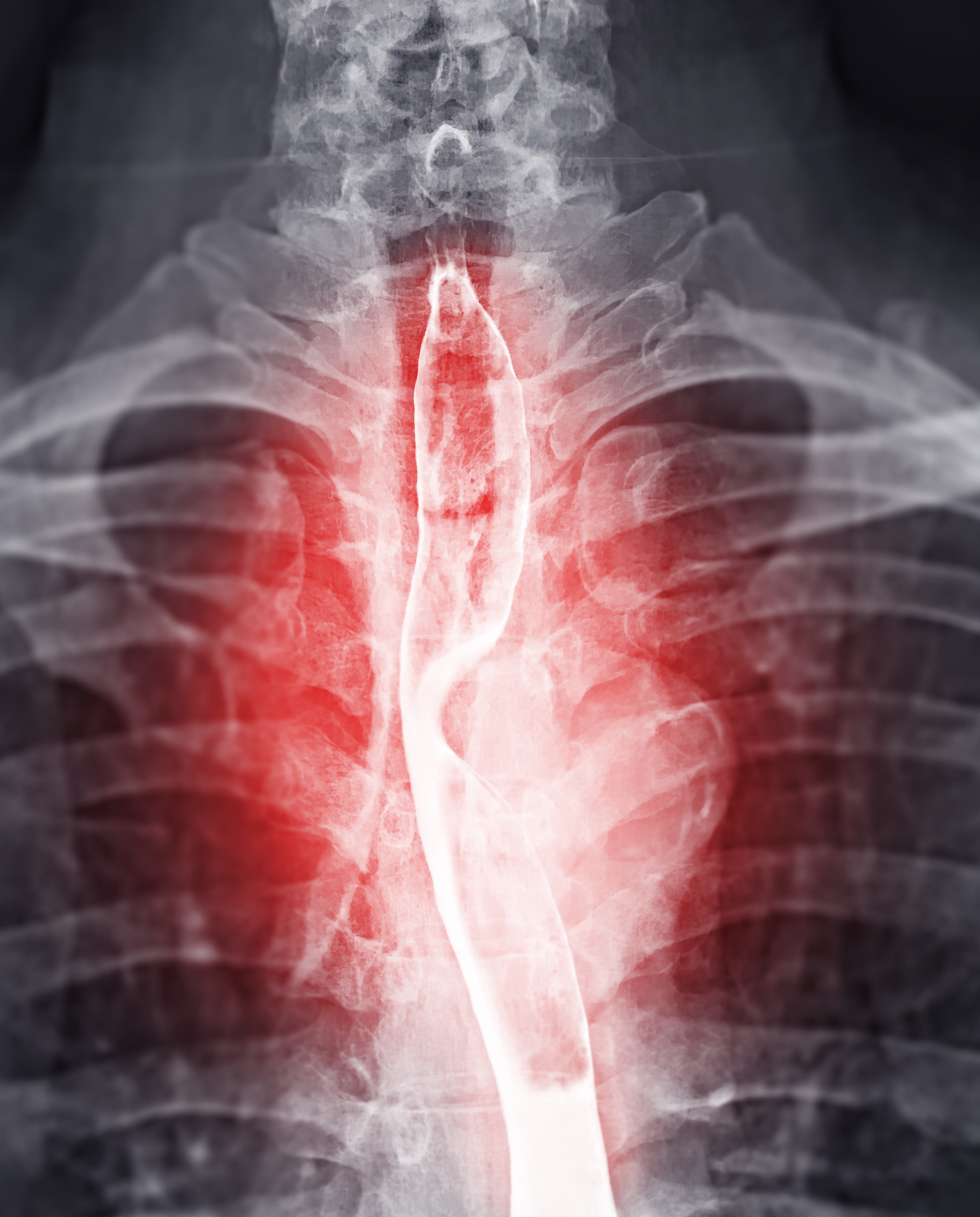 Røntgen av et menneskelig bryst som fremhever spiserøret med et lyst område som indikerer potensiell medisinsk bekymring