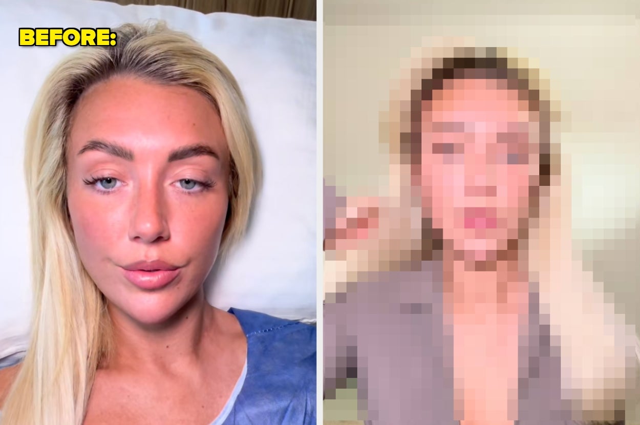 This "Love Island" Star Just Got Fox Eye Surgery, And The Results Are Wild