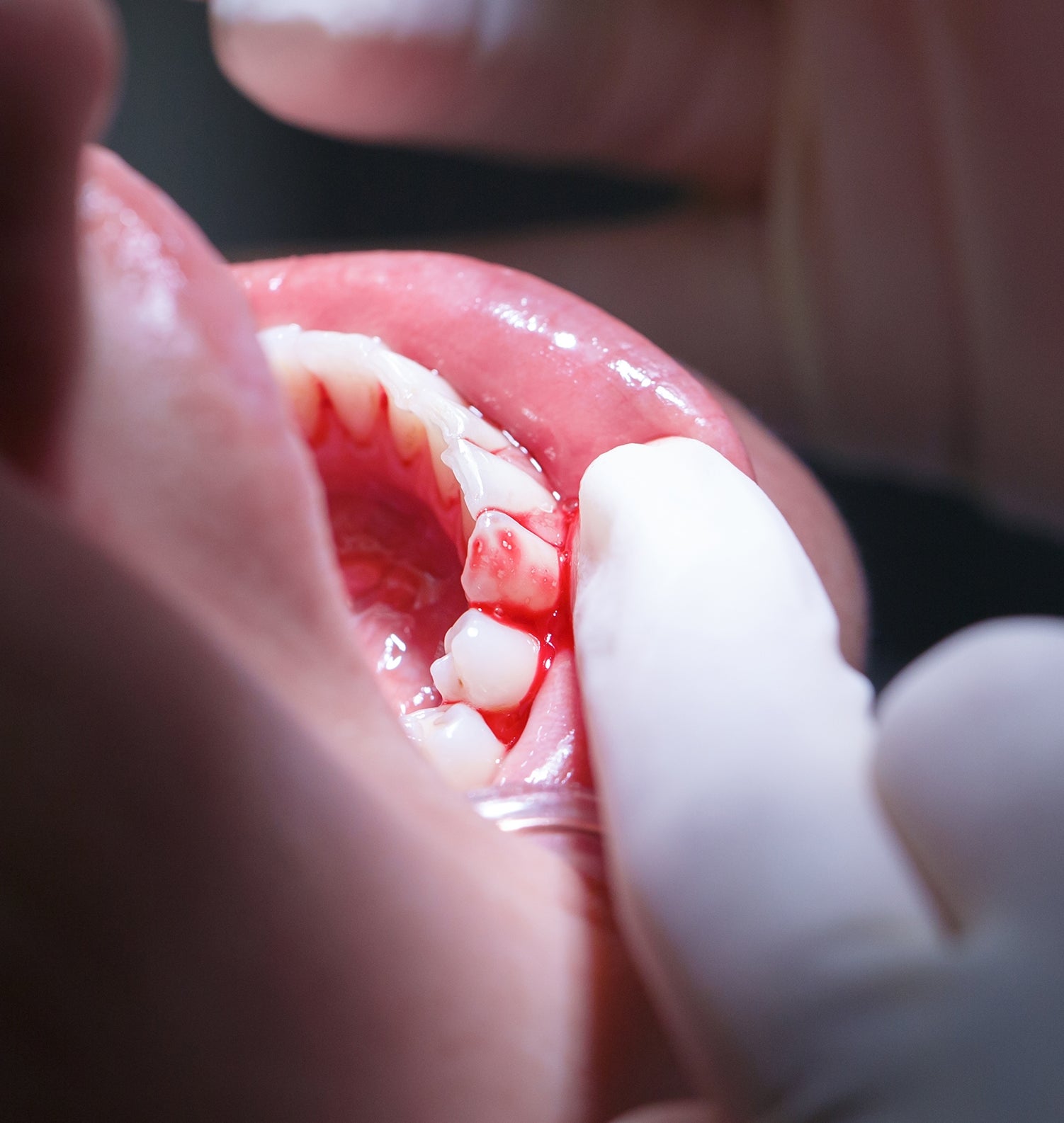 Tannlege i hans hansker utfører en tannprosedyre på en pasients åpne munn ved hjelp av tannverktøy