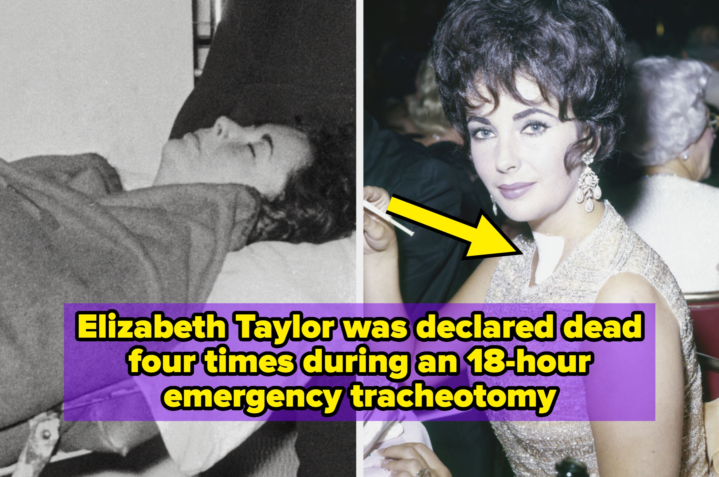 Elizabeth Taylor, lying in a hospital bed (left) and wearing a glamorous gown with a tracheotomy scar visible (right), survived a critical surgery