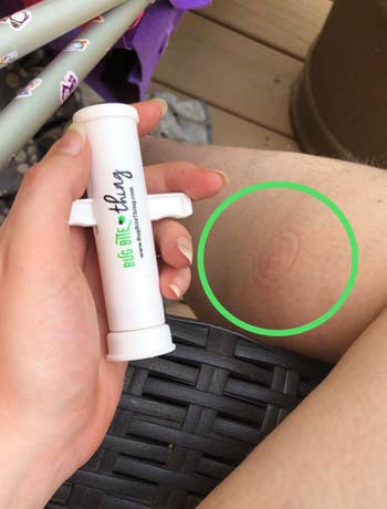 Reviewer holding Bug Bite Thing with their limb successful the inheritance showing a ringing wherever they suctioned retired a bug bite