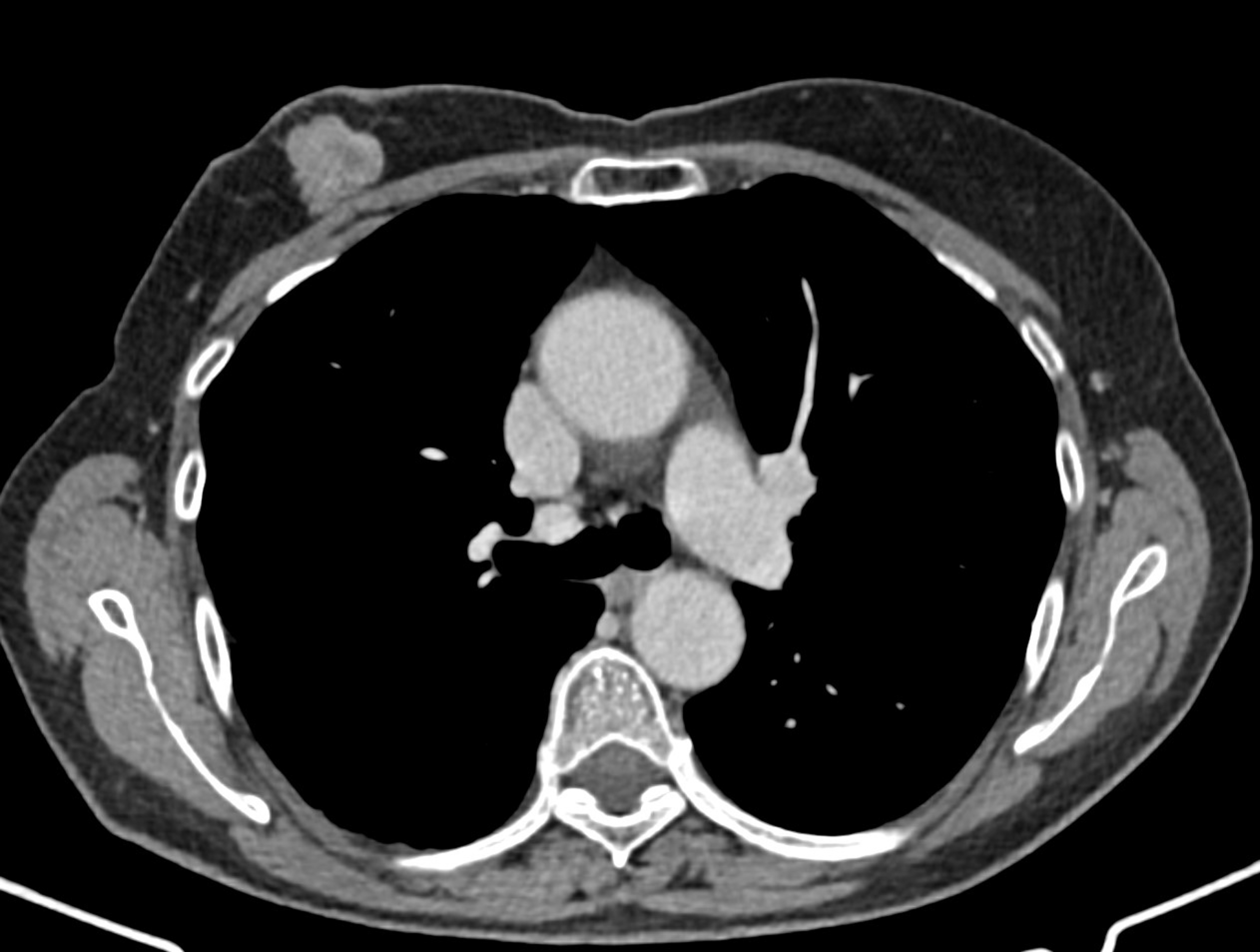 CT-skanning av et menneskelig bryst, som viser hjertet, lunger og omkringliggende strukturer i tverrsnitt