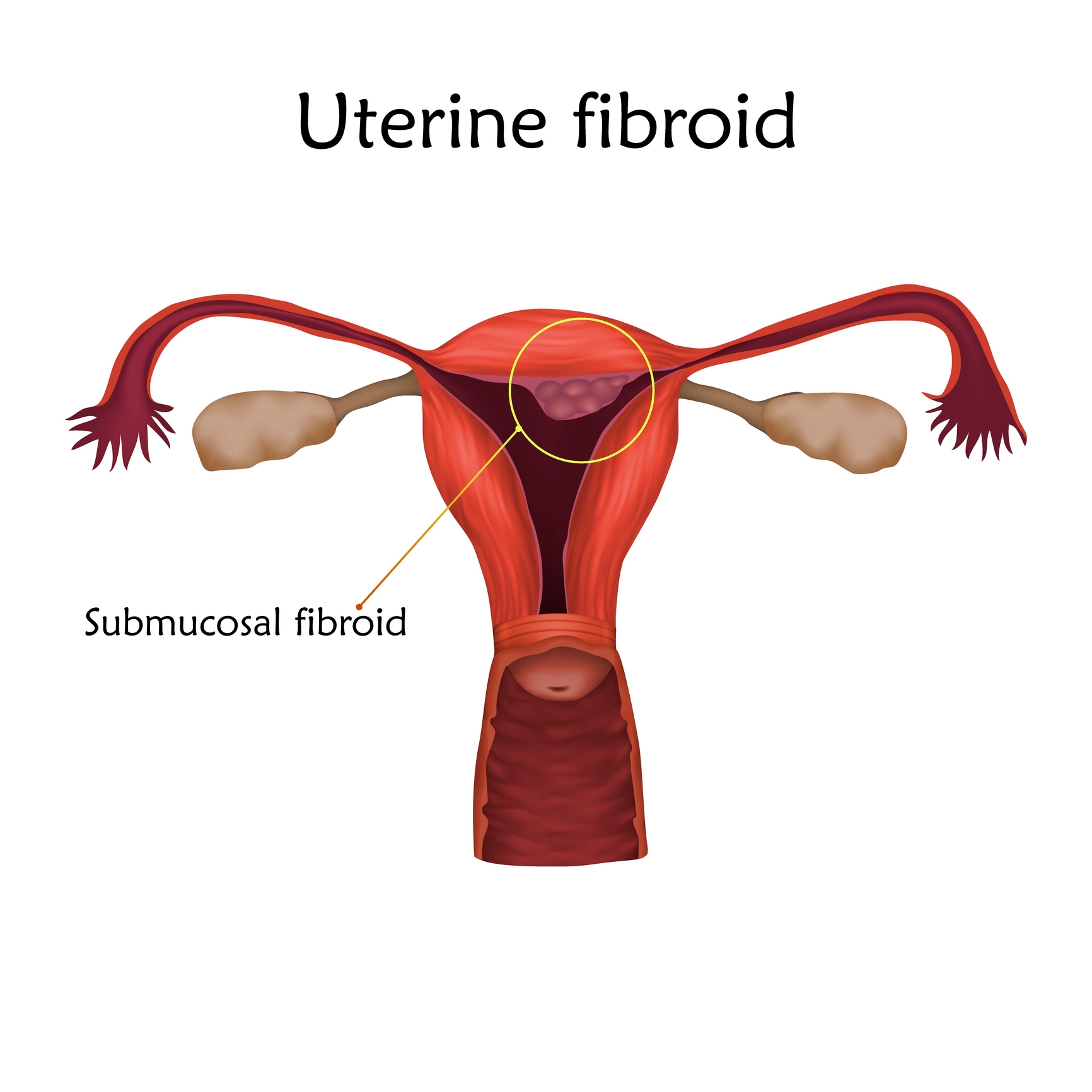 Diagram of a uterus showing a distinct submucosal fibroid inside