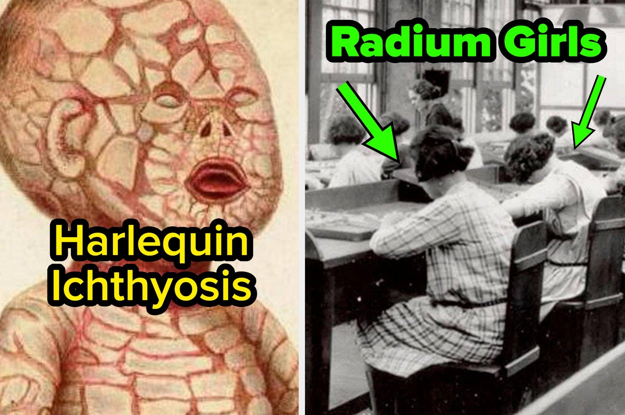The left image shows an illustrated baby with Harlequin Ichthyosis. The right image shows women, labeled "Radium Girls," working in a factory