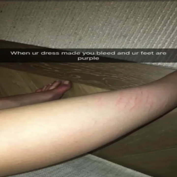 Leg with scratches; caption above reads: "When ur dress made you bleed and ur feet are purple."