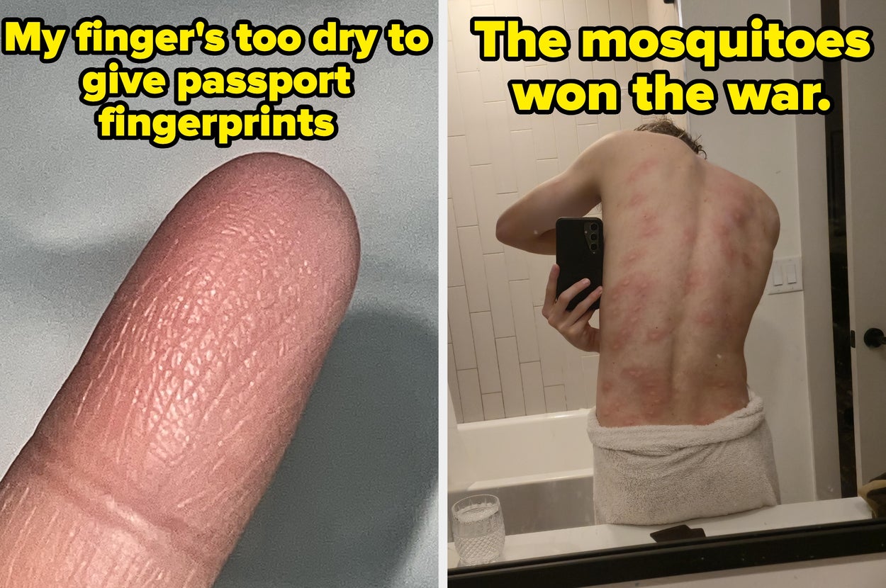 A dry fingertip unable to give fingerprints and a person showing a mosquito-bitten back in a mirror selfie