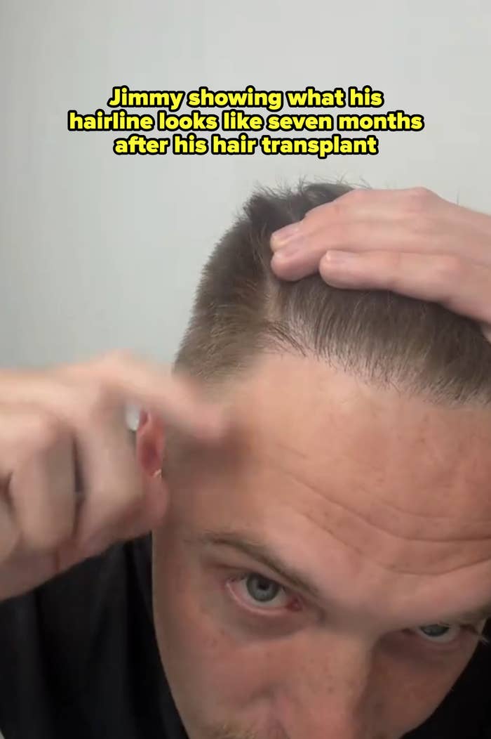 Jimmy showing what his hairline looks like seven months after his hair transplant. It appears full with some bangs coming in