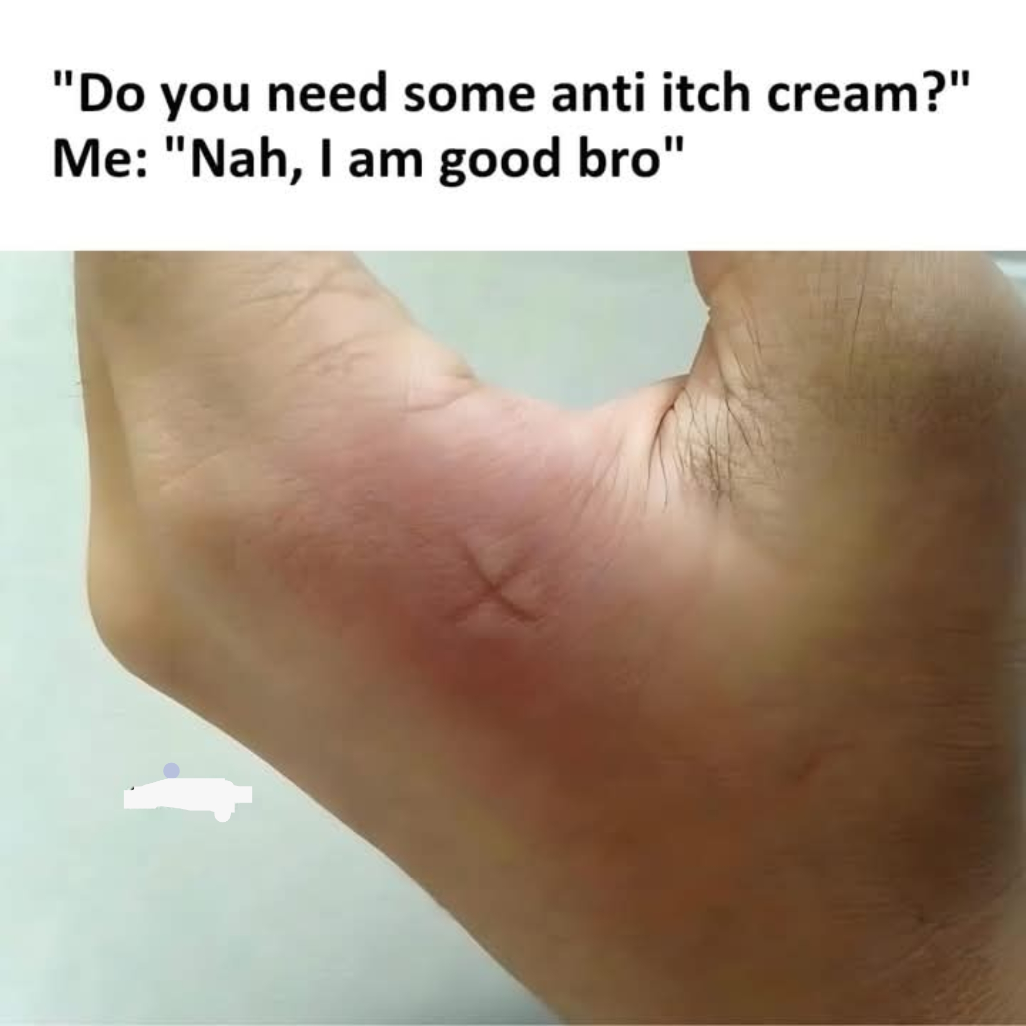 Image of a reddened and swollen foot, humorously described as &quot;Nah, I am good bro&quot; in response to a question about needing itch cream