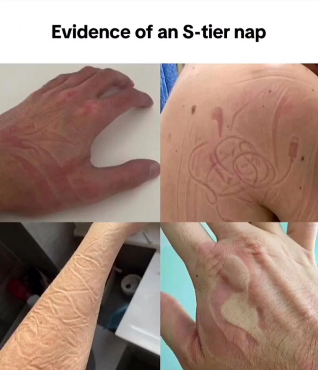 Four images showing skin imprints on arms and hands from a deep nap, each illustrating various patterns left by fabric or objects