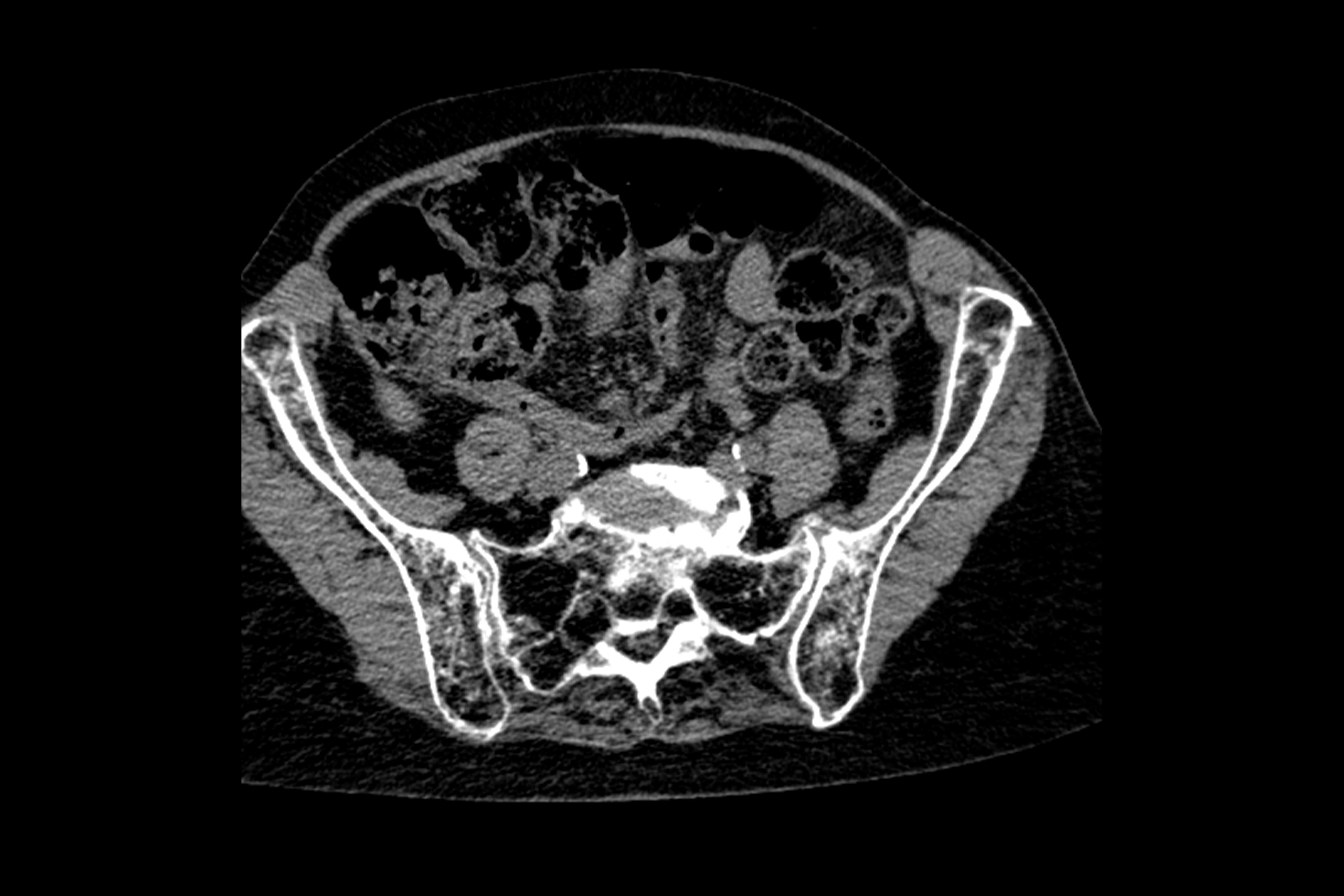 En gråtonescale Abdominal CT -skanning som viser bein, organer og vev