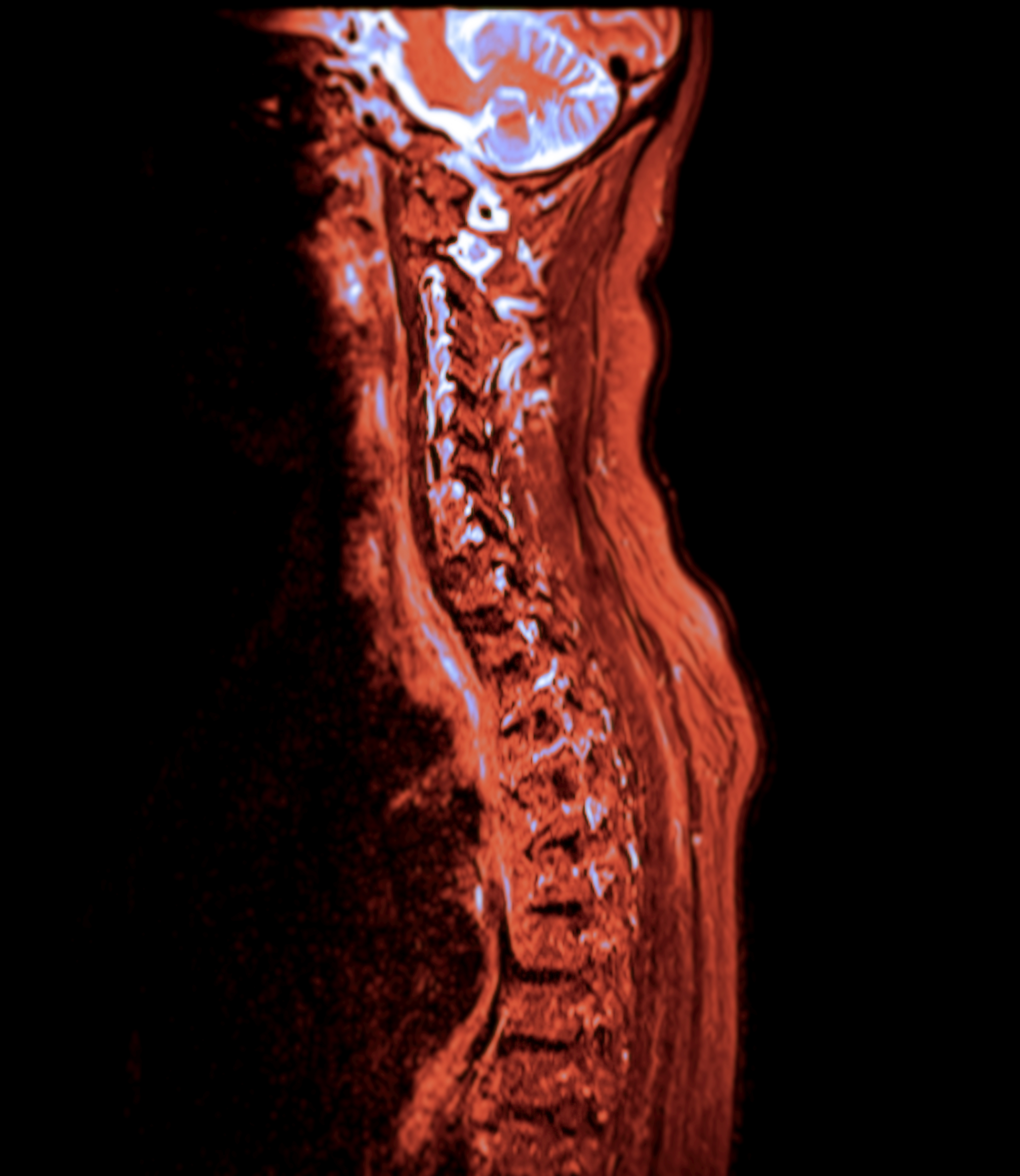 MR -skanning av nakken og øvre ryggraden som viser ryggvirvelinnretting og hjernestruktur
