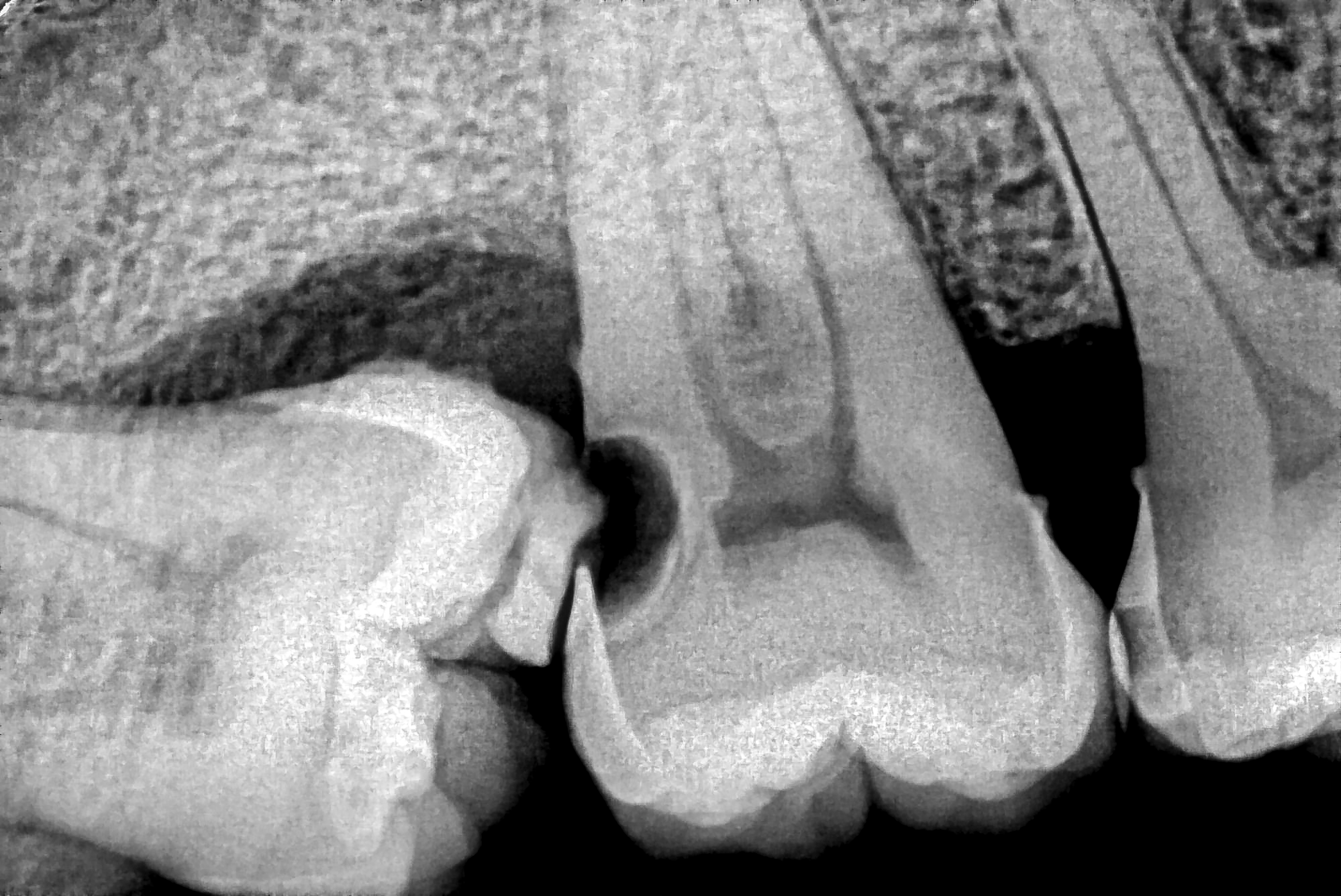 Tann røntgenbilde som viser tre tenner, fremhever mulig forfall eller en abscess i nærheten av sentrumstannen