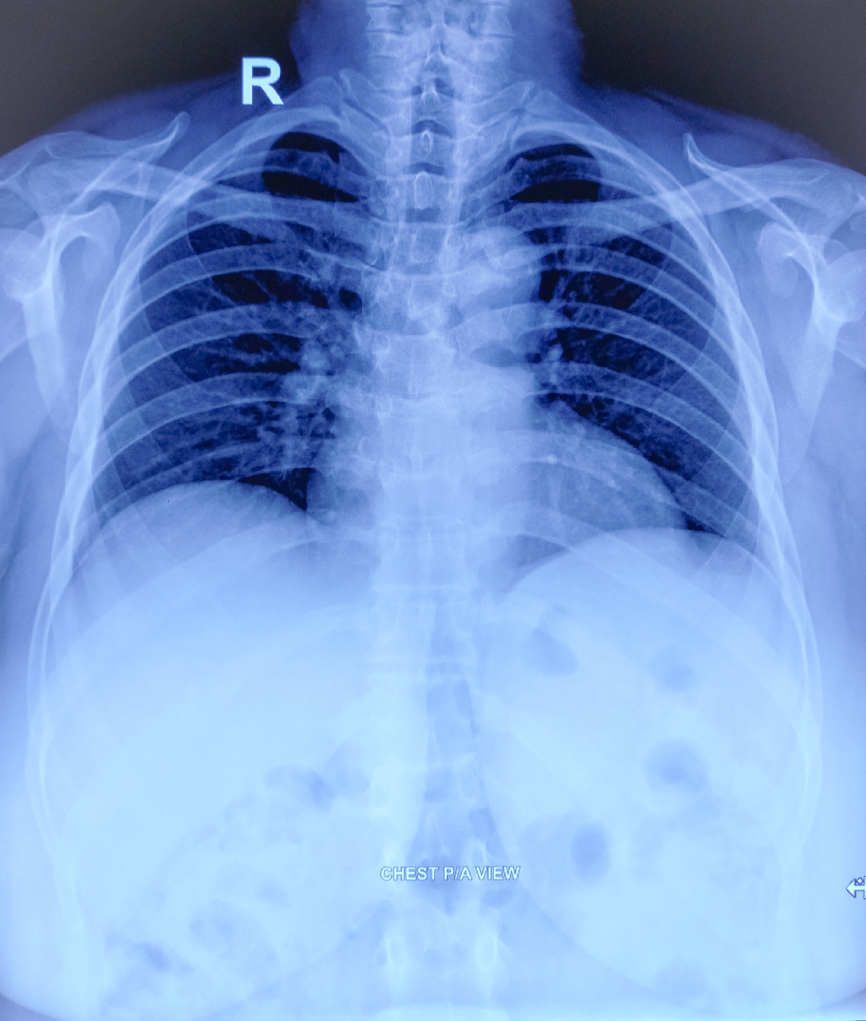 Røntgenbilde som viser fremre utsikt over et menneskelig bryst, inkludert ribbeina, ryggraden og synlige lungeområder