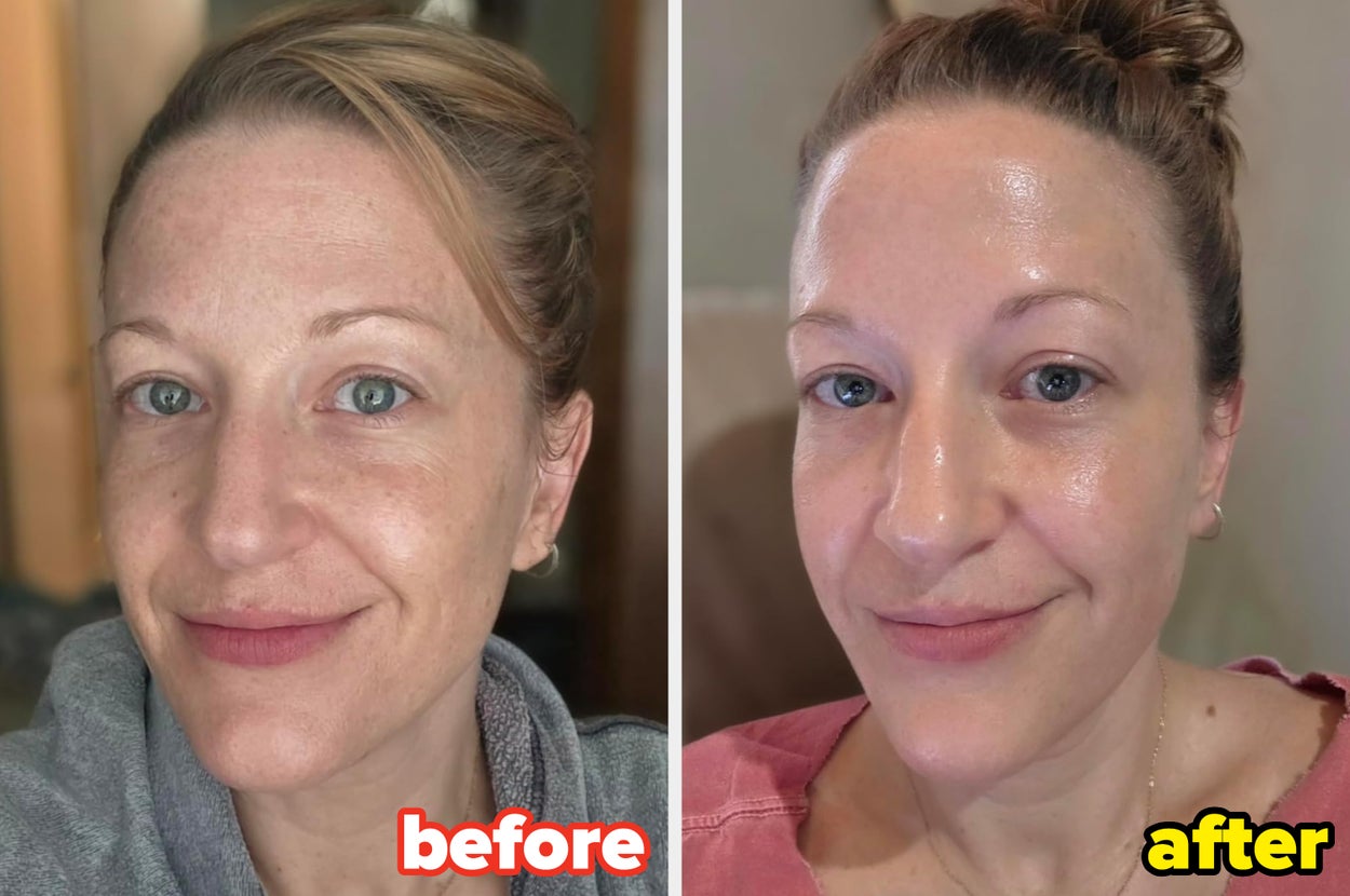 reviewer's skin before and after using K-beauty serum