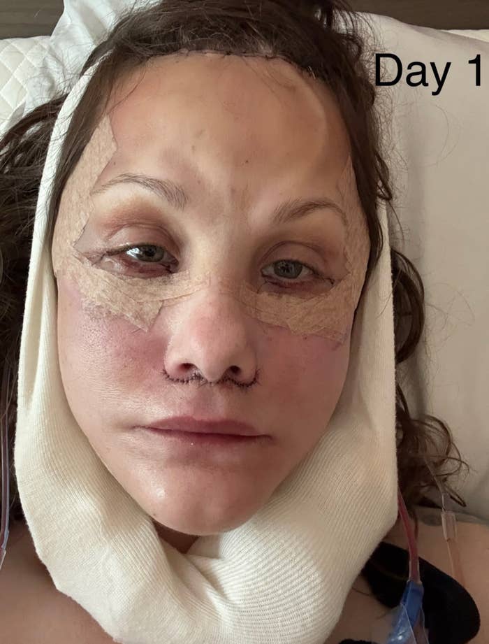 Person lying down with facial bandages post-surgery, labeled "Day 1." They appear to be in recovery